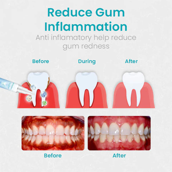 Gum Therapy Gel